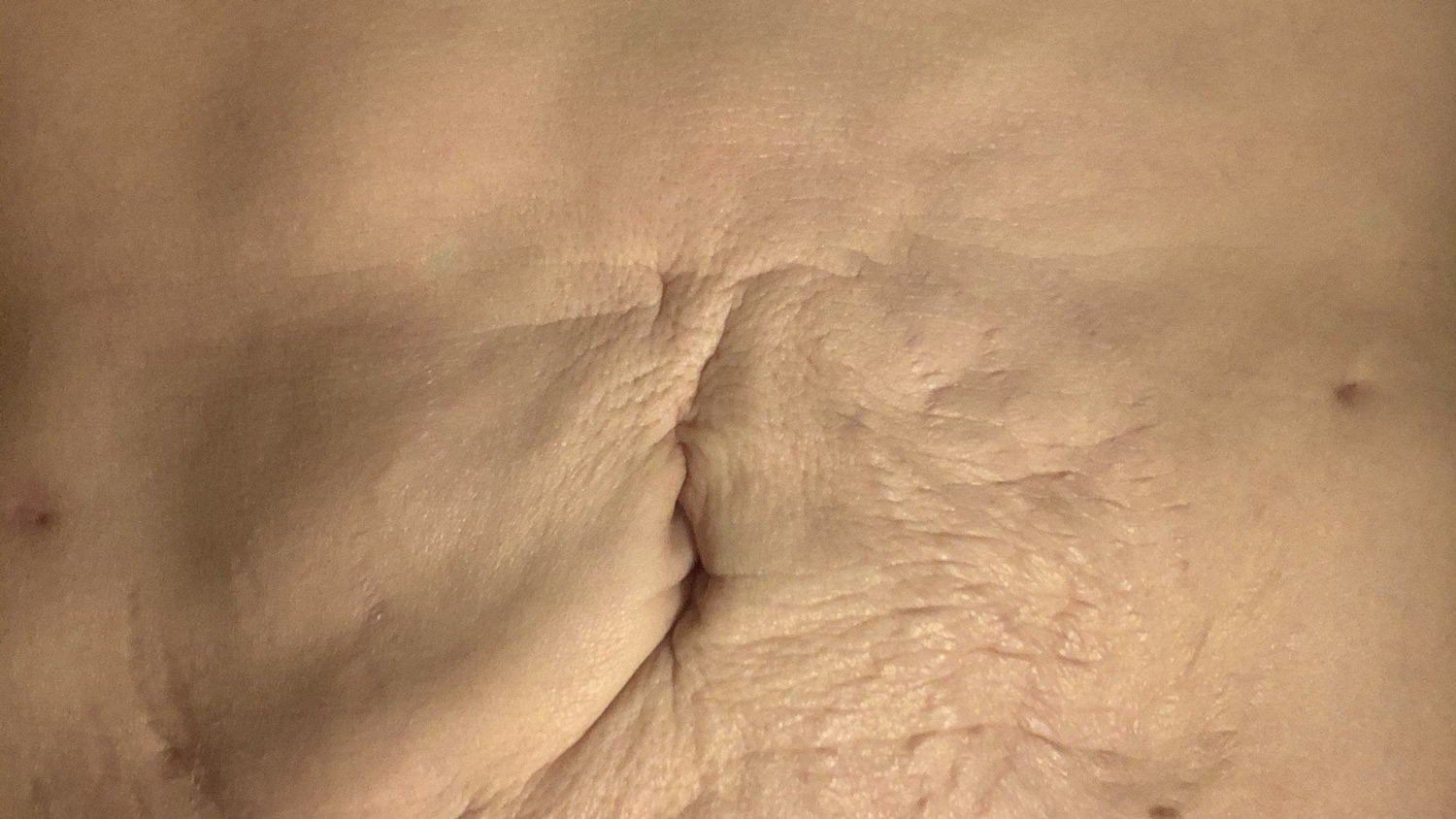 vatsan-rasvaimu-virossa-komplikaatio-kiinnikkeet Epätasaisesti ja liian rajulla tekniikalla tehty rasvaimu Virossa. Paikoin rasvaa on jätetty paljon, paikoin otettu liikaa. Liian rajulla tekniikalla on aiheutettu kiinnikkeitä, jotka näkyvät kuroumina