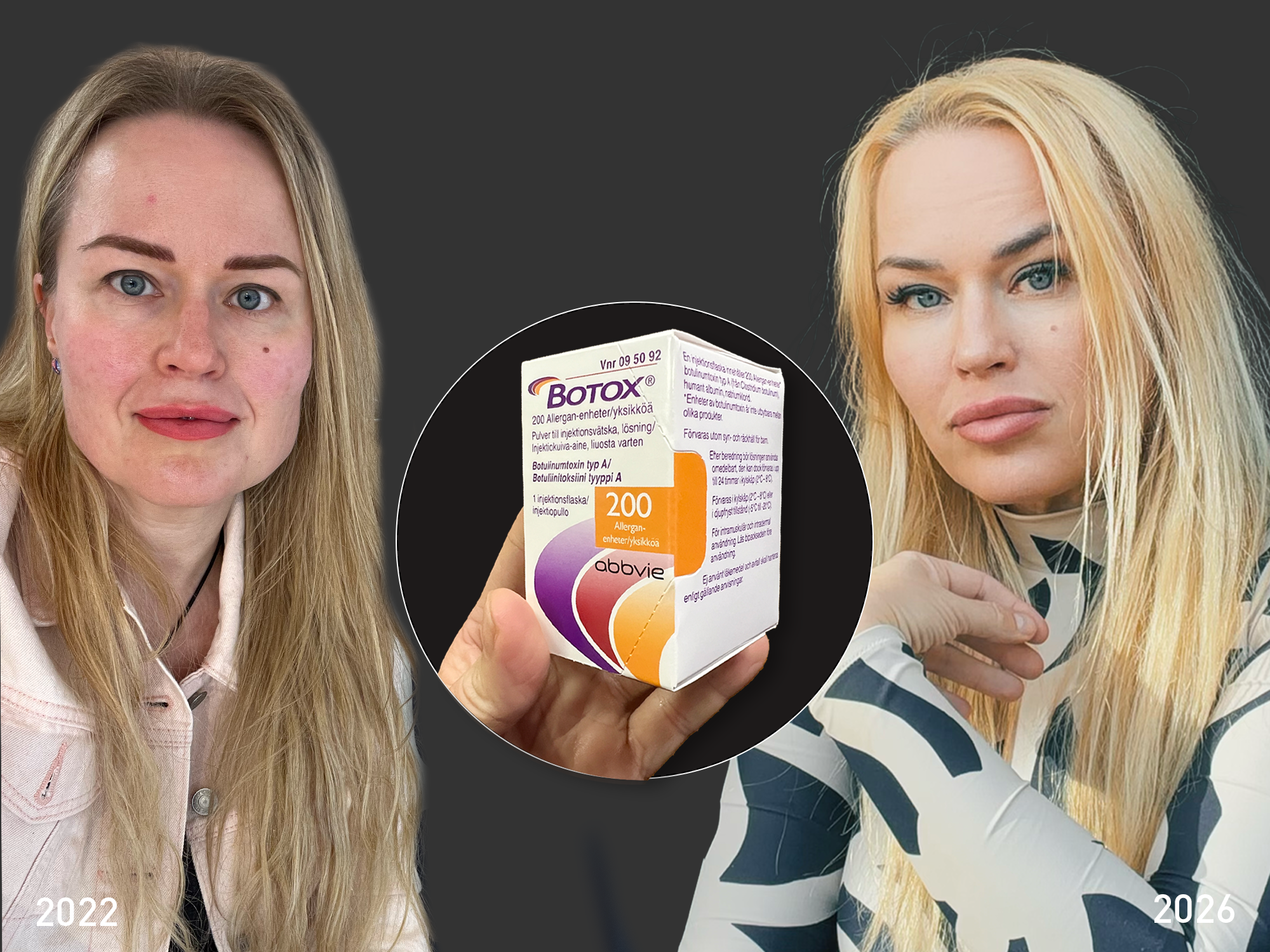 Esteetinen botuliinihoito, näin kasvot ovat muuttuneet neljässä vuodessa