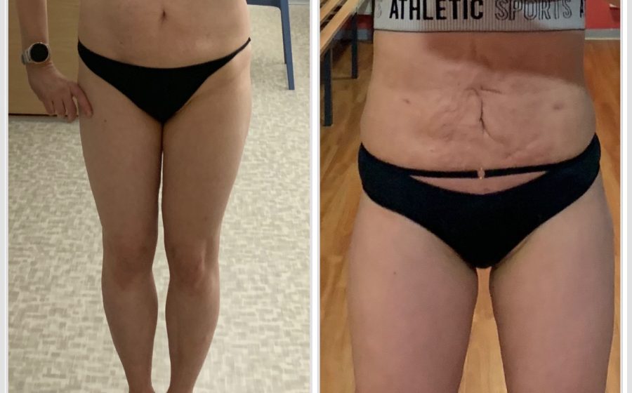 Vatsan rasvaimu kokemuksia, ennen ja jälkeen, epäonnistunut lopputulos