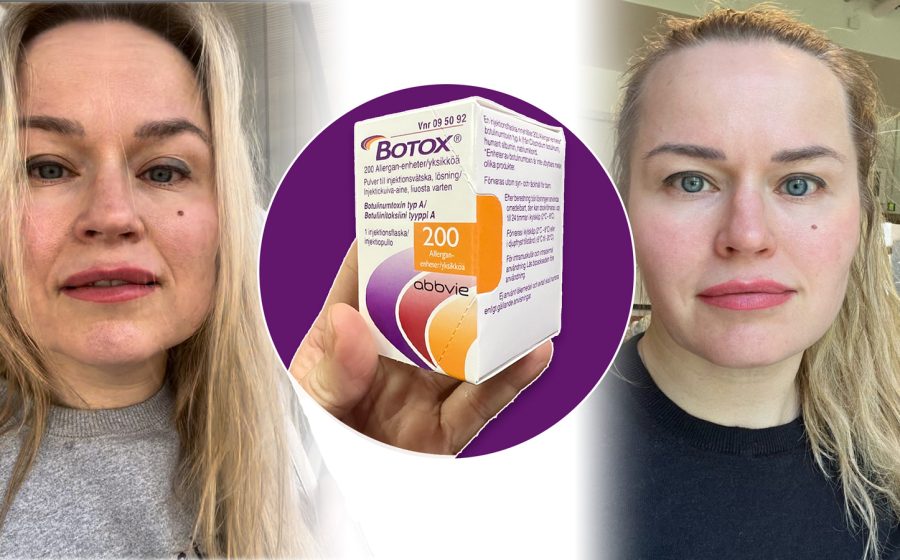 botox-toimittajatestasi